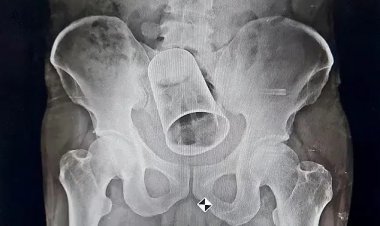 'Amigos' enfiam copo de aço no ânus de homem durante 'brincadeira'