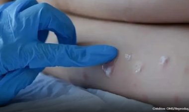 Brasil é o terceiro país do mundo com mais casos de Varíola dos Macacos