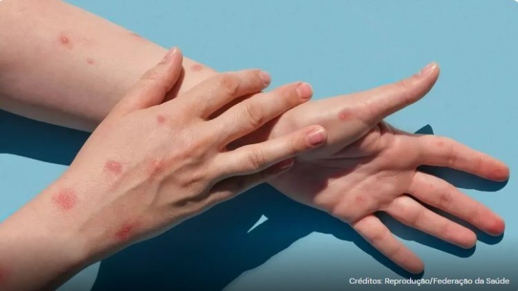 Betim confirma 3º caso da varíola dos macacos: paciente é uma mulher que estava grávida