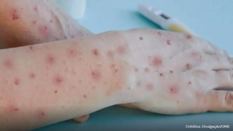 Minas Gerais registra 159 casos da Varíola dos Macacos