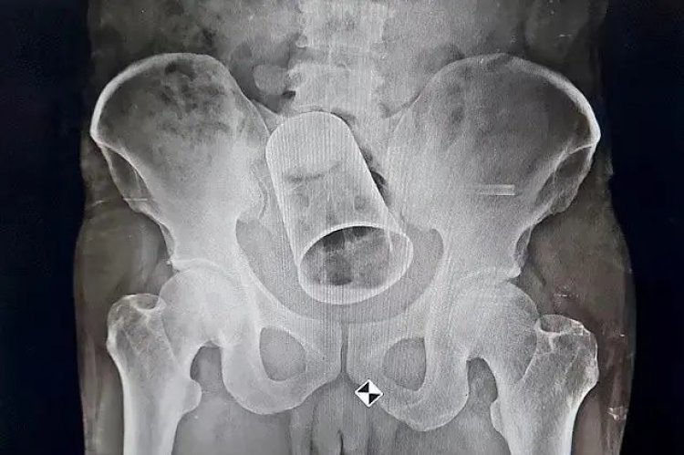 'Amigos' enfiam copo de aço no ânus de homem durante 'brincadeira'