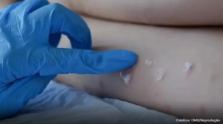 Brasil é o terceiro país do mundo com mais casos de Varíola dos Macacos