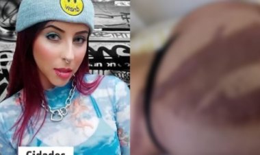 DJ sofre queimaduras após passar por bronzeamento artificial em MG: "Abalada"