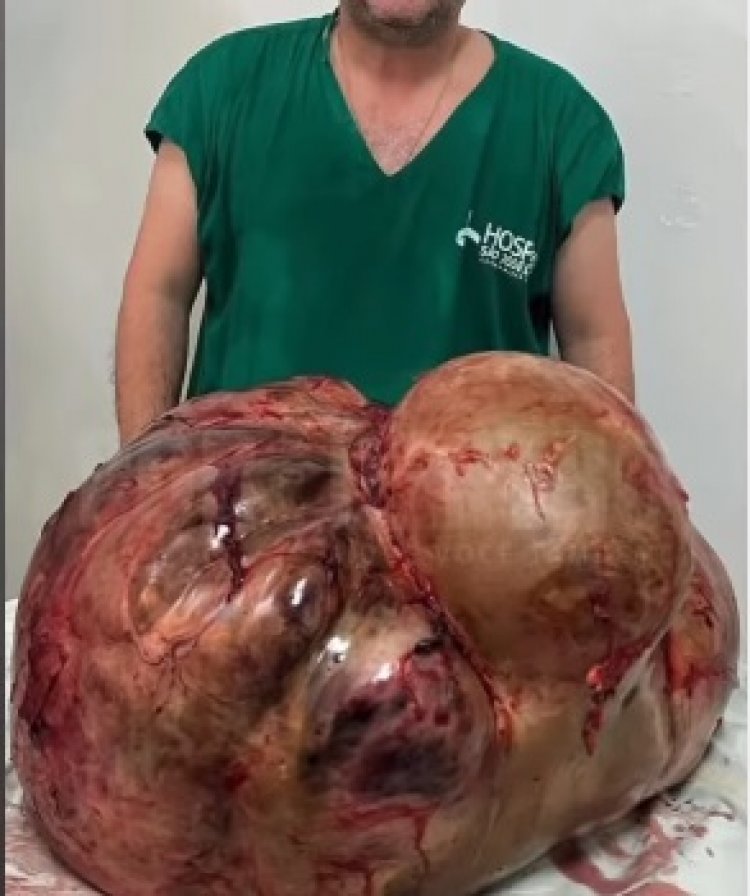 Mulher é operada e retira 46 kg de tumor