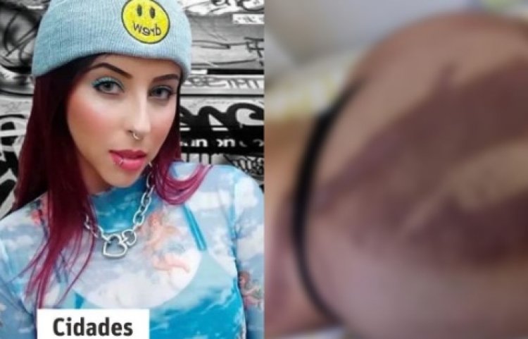 DJ sofre queimaduras após passar por bronzeamento artificial em MG: "Abalada"