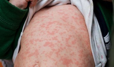 Sarampo: com crianças sem vacinação, OMS alerta para crescente ameaça mundial