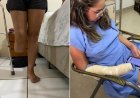 Mulher tem perna e dedos amputados depois de lipoaspiração