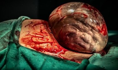 Fotógrafra registra nascimento de bebê empelicado em MG e imagem surpreende: ‘Momento ímpar’