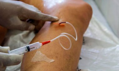 Tratamento de varizes leva à internação de 145 mulheres por dia no Brasil