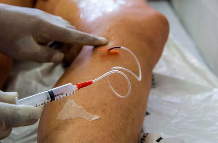 Tratamento de varizes leva à internação de 145 mulheres por dia no Brasil