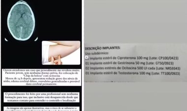 'Chip da beleza' com ocitocina: implante hormonal 'turbinado' leva jovem para UTI; veja os riscos