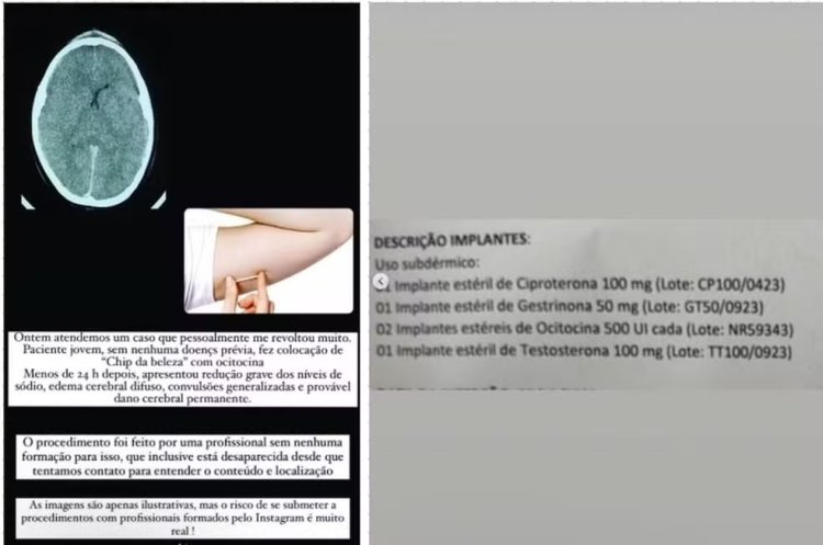 'Chip da beleza' com ocitocina: implante hormonal 'turbinado' leva jovem para UTI; veja os riscos