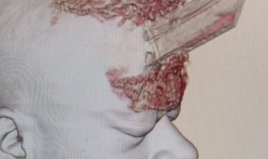 Pedreiro tem crânio perfurado por estaca de madeira durante obra e sobrevive; imagem é impressionante