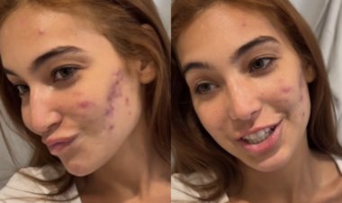 Em tratamento para acne, Vanessa Lopes relata ter se acostumado com ofensas