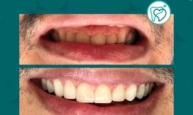 VITA ALLEGRA TRAZENDO RESULTADO DE UM SORRISO LINDO E NATURAL