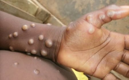 Suspeita de Mpox em estudantes coloca escolas de Sete Lagoas em alerta