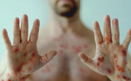 Sete Lagoas investiga dois casos suspeitos de mpox: pacientes estão em isolamento domiciliar