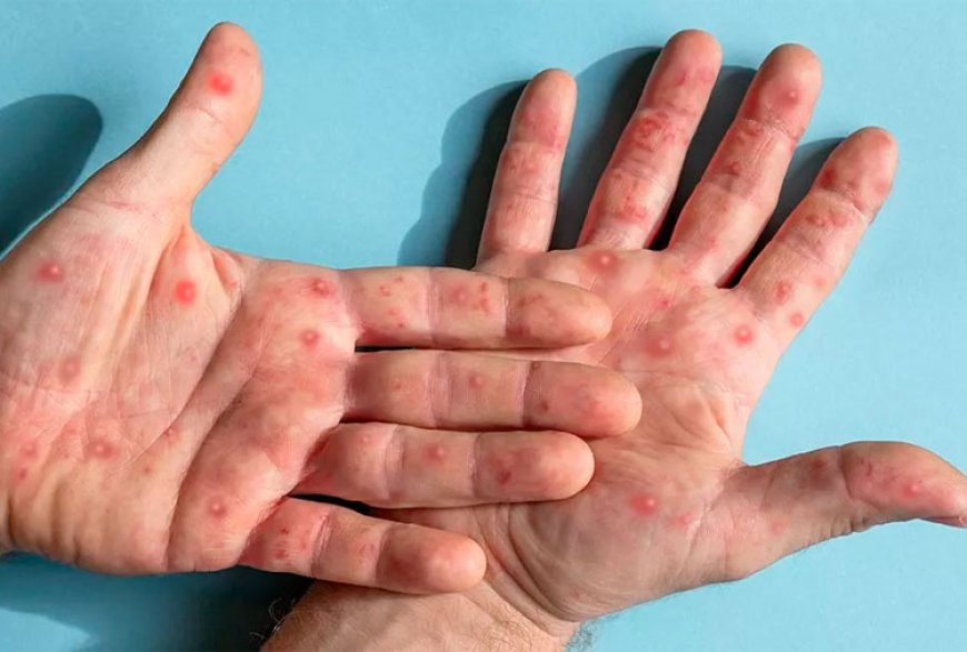 Suspeita de Mpox em Sete Lagoas: pacientes monitorados apresentam recuperação