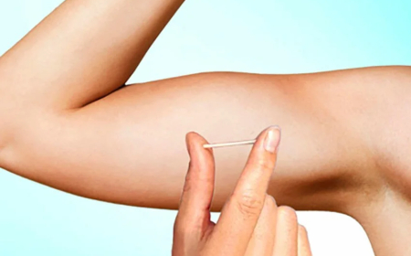 Planos de saúde terão de oferecer implante contraceptivo hormonal