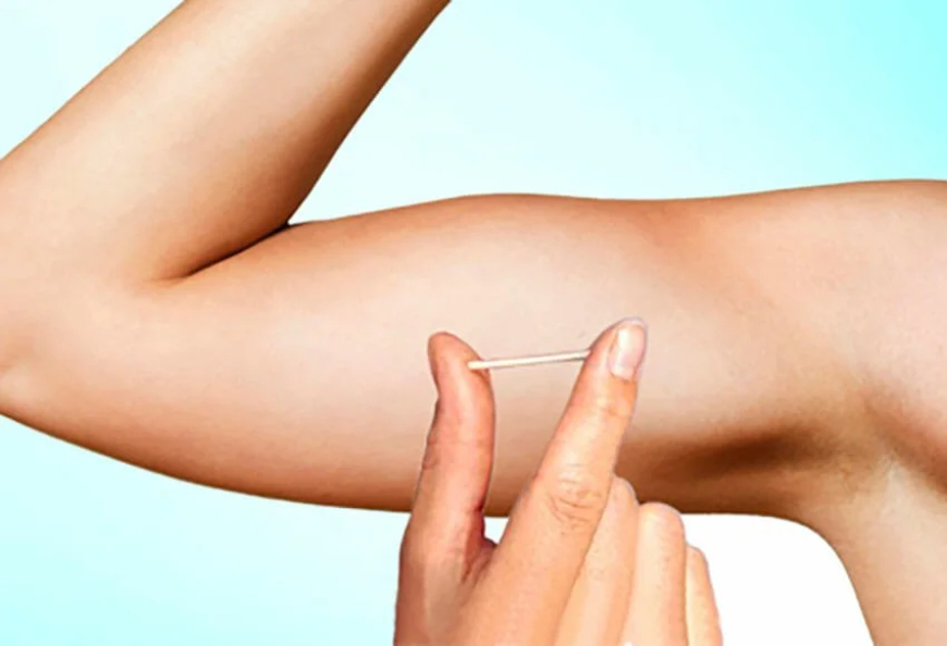 Planos de saúde terão de oferecer implante contraceptivo hormonal